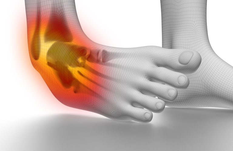 11-09-Acute peesruptuur tibialis posterior komt vaker voor dan gedacht_227120620 11-09-Acute peesruptuur tibialis posterior komt vaker voor dan gedacht_227120620