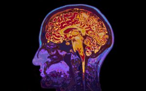 Breindoornsnede onder een MRi scan.