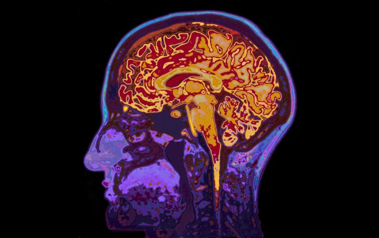 Breindoornsnede onder een MRi scan.