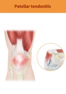 Anatomische tekening van de voorzijde van de knie.