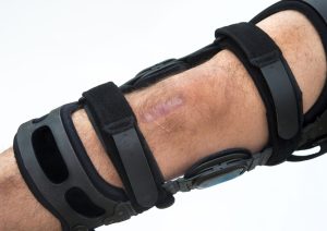 Knie brace na VKB reconstructie.