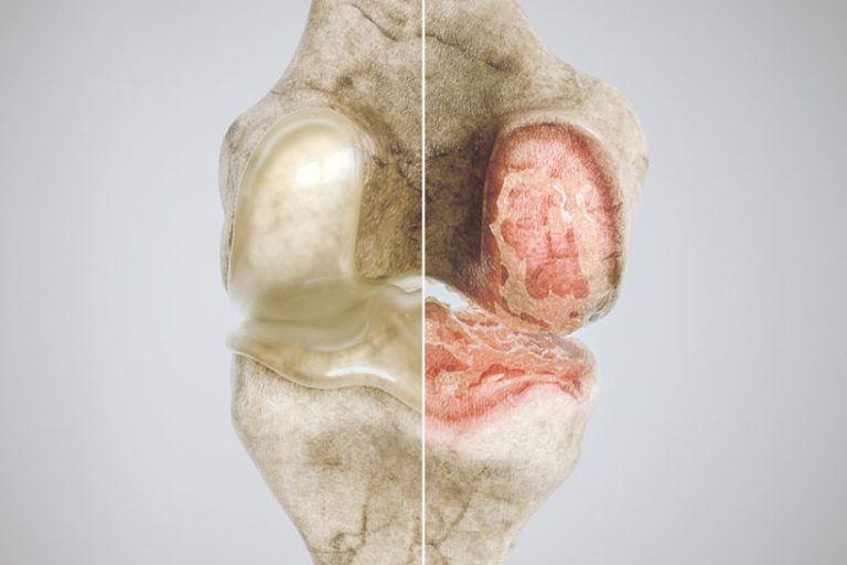 Healthy healthy knee and osteoarthritis knee in comparison - high degree of detail -- 3D Rendering