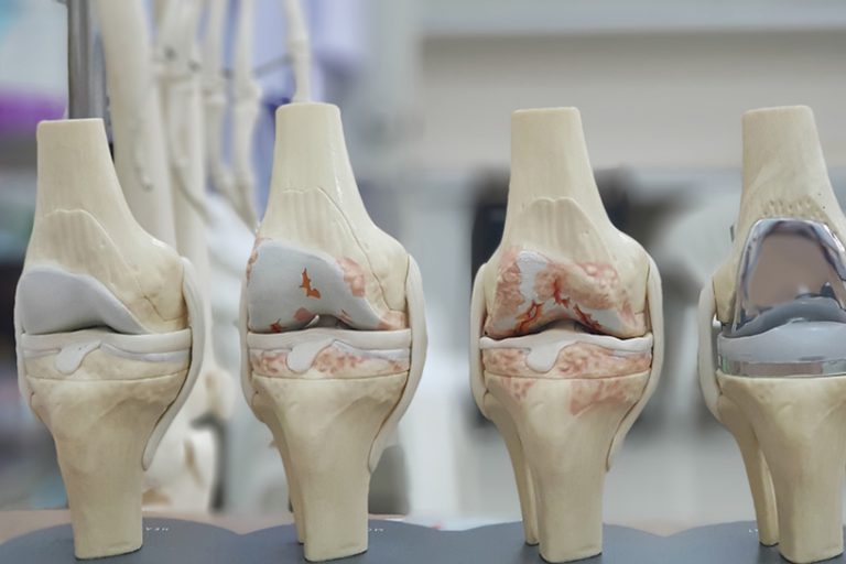Model Model of knee joint showing multiple stages of knee osteoarthritis(OA knee) and total knee replacement(TKR). Blurred skeletal model and examination room background.