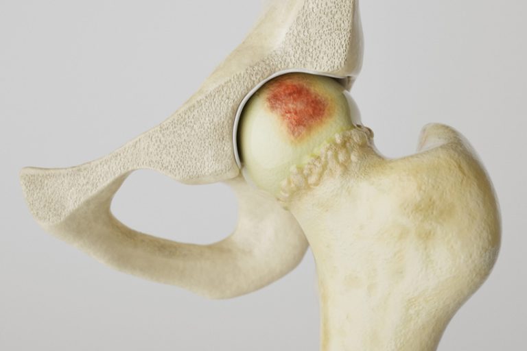 Stronger Stronger artheritis on the hip joint - high degree of detail -- 3D Rendering