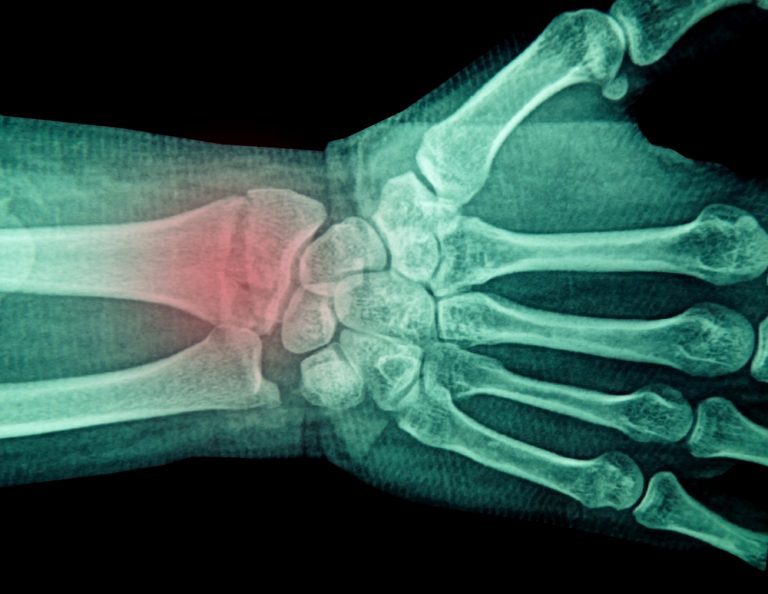 9-06-Baseline pijn bij distale radius fractuur voorspellend voor chronische pijnklachten_196420220 9-06-Baseline pijn bij distale radius fractuur voorspellend voor chronische pijnklachten_196420220