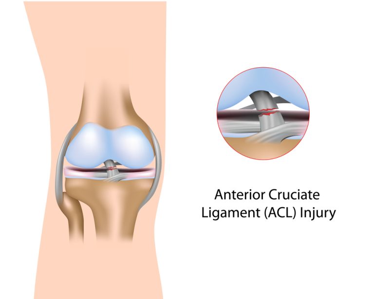 9-09-Effecten van voorste kruisband letsel op propriocepsis niet klinisch relevant-b-shutterstock_125579738 9-09-Effecten van voorste kruisband letsel op propriocepsis niet klinisch relevant-b-shutterstock_125579738