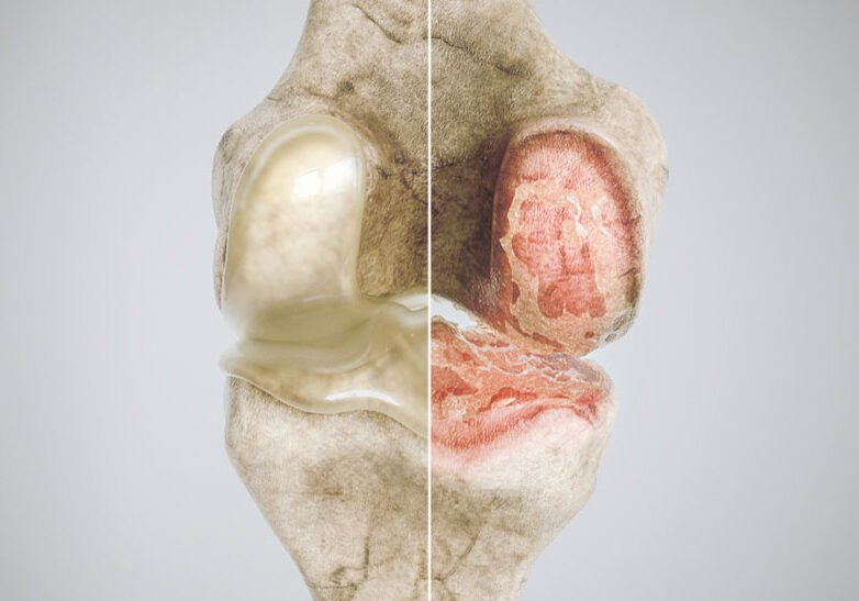 healthy knee and osteoarthritis knee in comparison - high degree of detail -- 3D Rendering