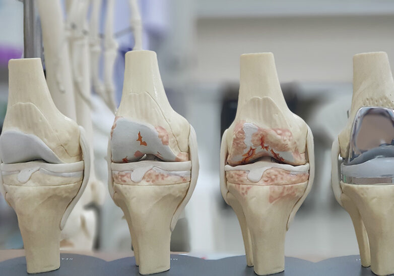 Model of knee joint showing multiple stages of knee osteoarthritis(OA knee) and total knee replacement(TKR). Blurred skeletal model and examination room background.