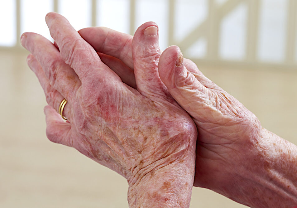 9-16-Copingstijlen bij handartrose aangrijpingspunt voor fysiotherapie_158373833